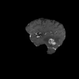brain tumor preview 4