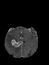 brain tumor preview 1