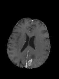 brain tumor preview 3