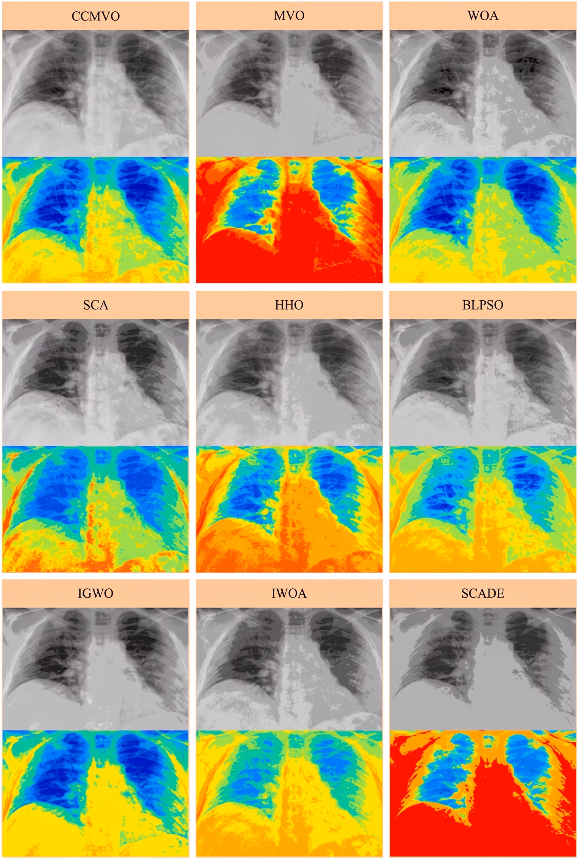 Using multi-level thresholding methods on chest X-rays