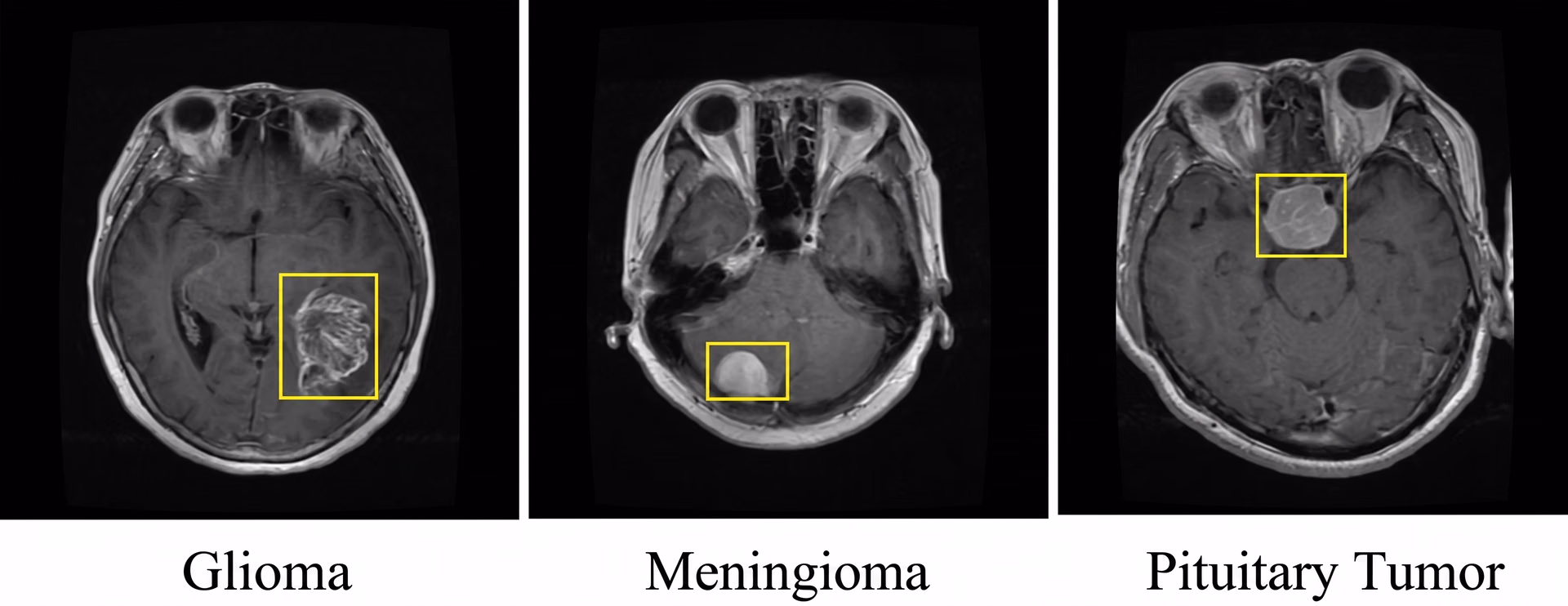 Detection of brain tumors using R-CNN
