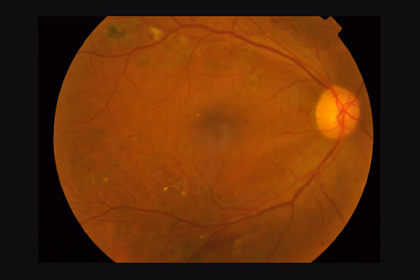 Un'immagine retinica elaborata da un assistente AI tramite MCP
