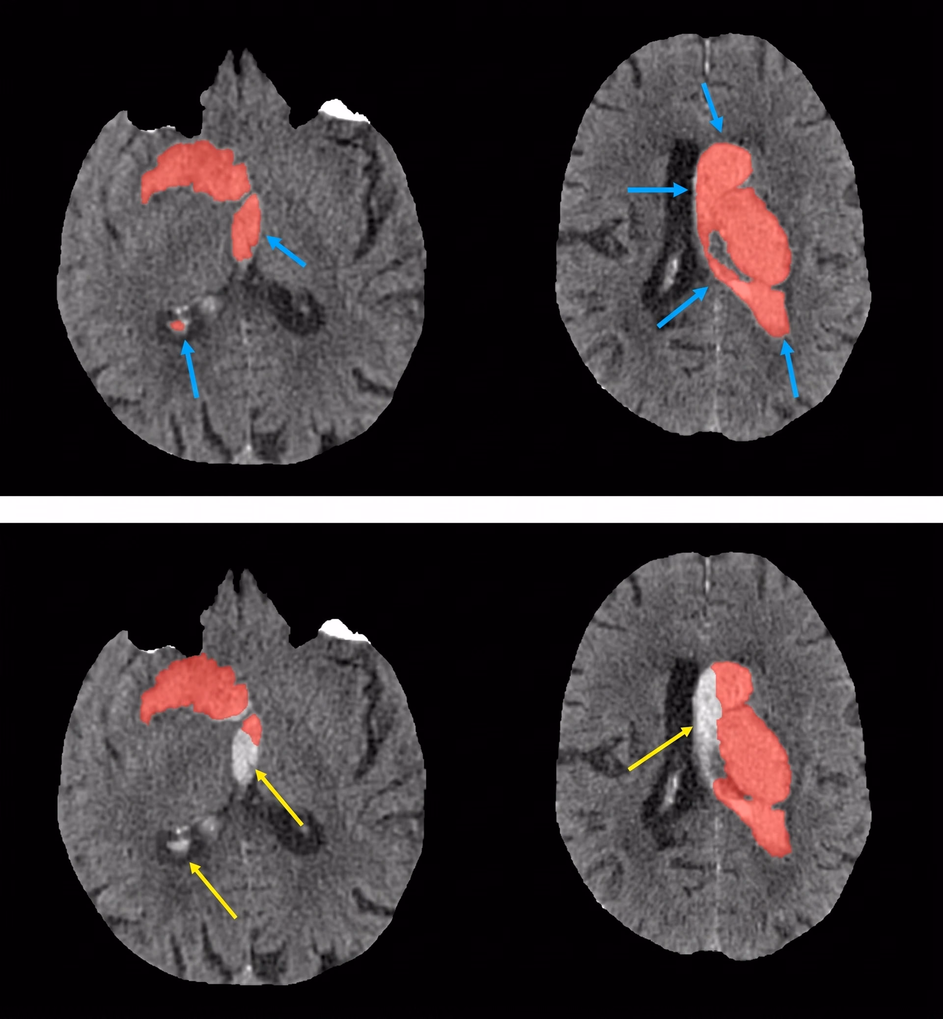 Segmentation of hemorrhagic stroke lesions in medical scans using 3D U-Net