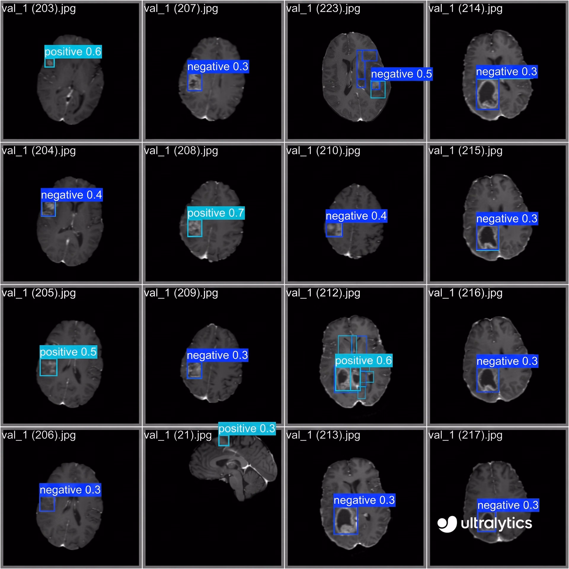 Tumor detection with Ultralytics YOLO11 in a brain MRI
