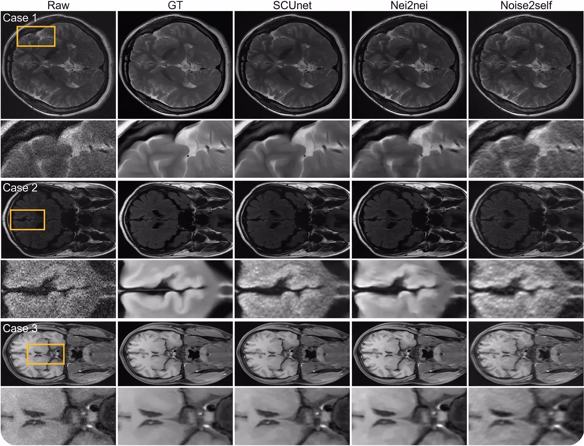 Self-supervised denoising techniques applied to brain MRI scans