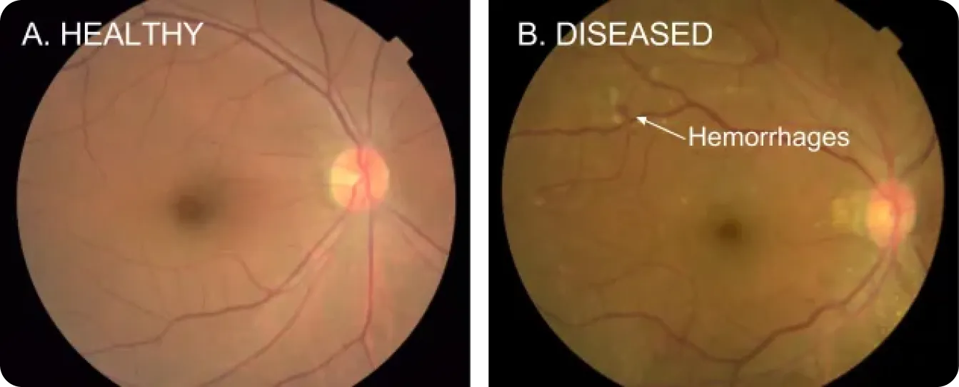 Uso de IA para detectar retinopatía diabética