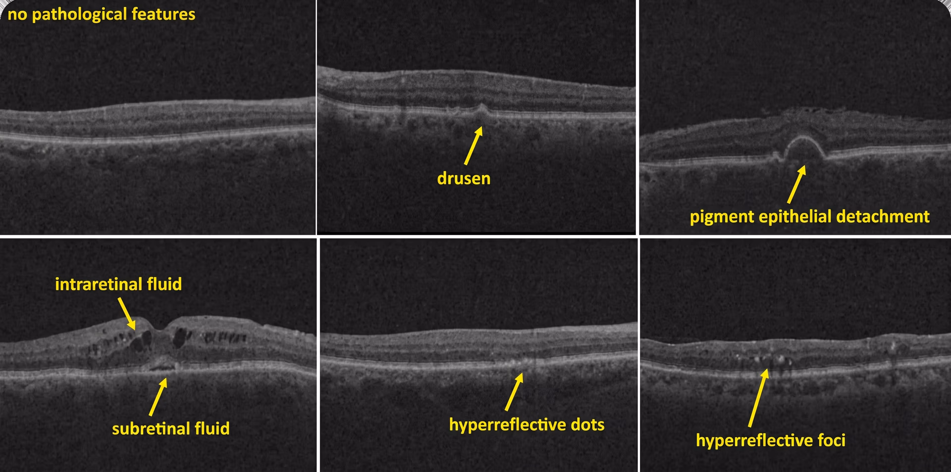 Examples of labels for different features related to retinal diseases