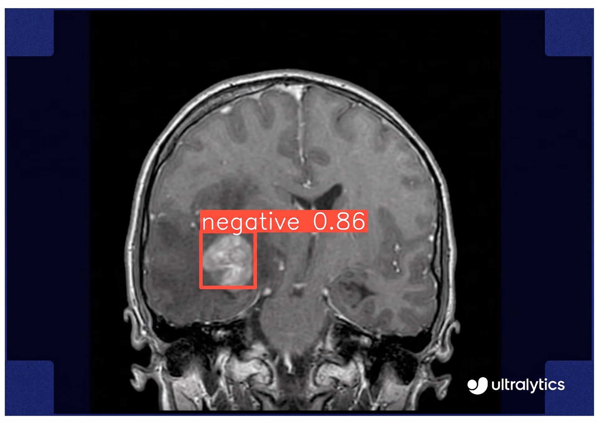 Brain tumor detection using Ultralytics YOLOv8