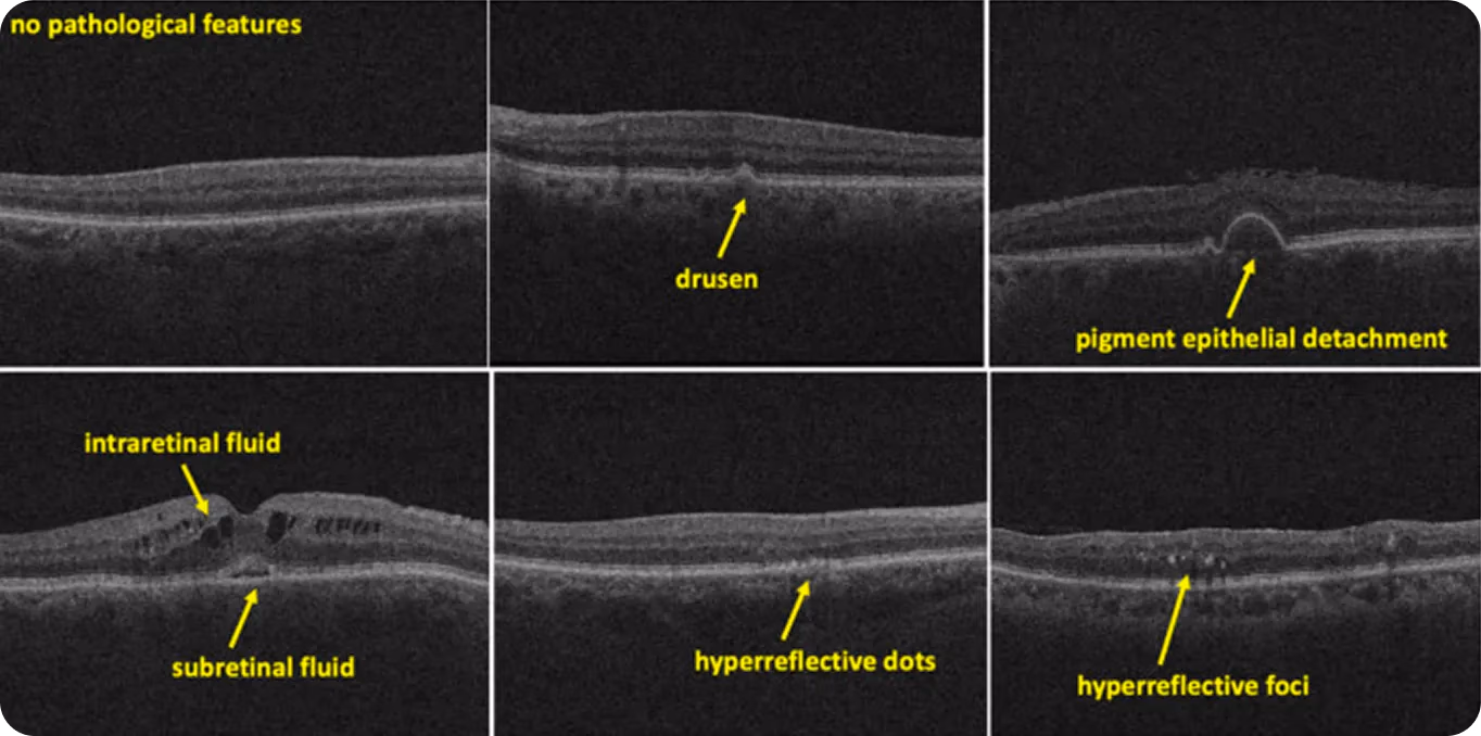 Ejemplos de etiquetas para diferentes características relacionadas con enfermedades retinianas