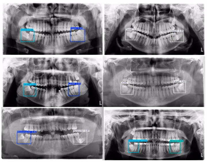 YOLO analysant une image de radiographie médicale