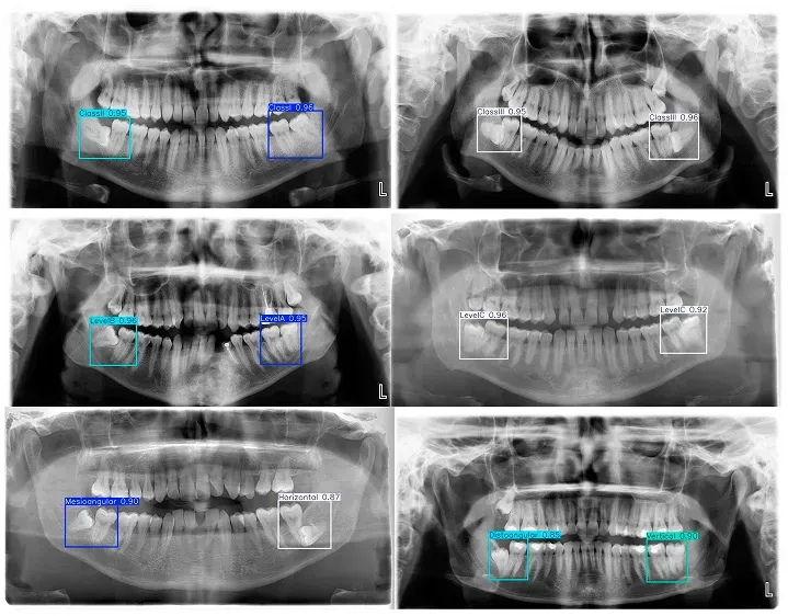 YOLO che analizza una radiografia medica