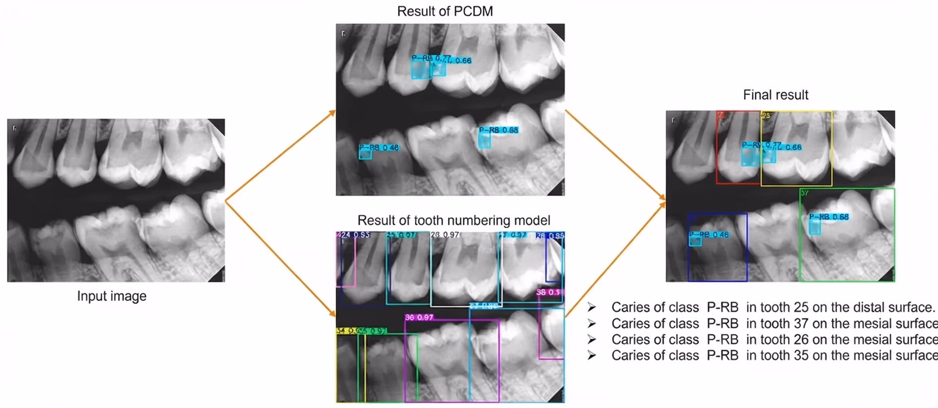 Detecting caries in dental X-rays using Ultralytics YOLO11