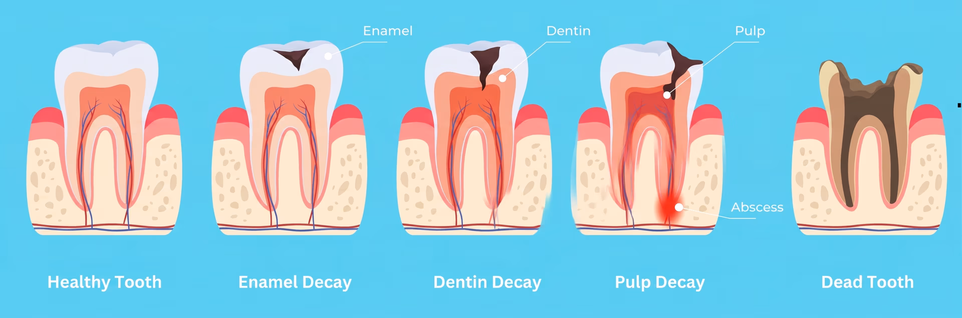The different stages of tooth decay