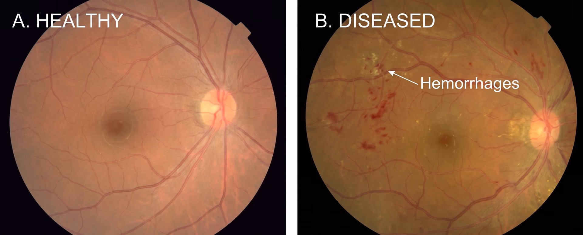 Using AI to detect diabetic retinopathy