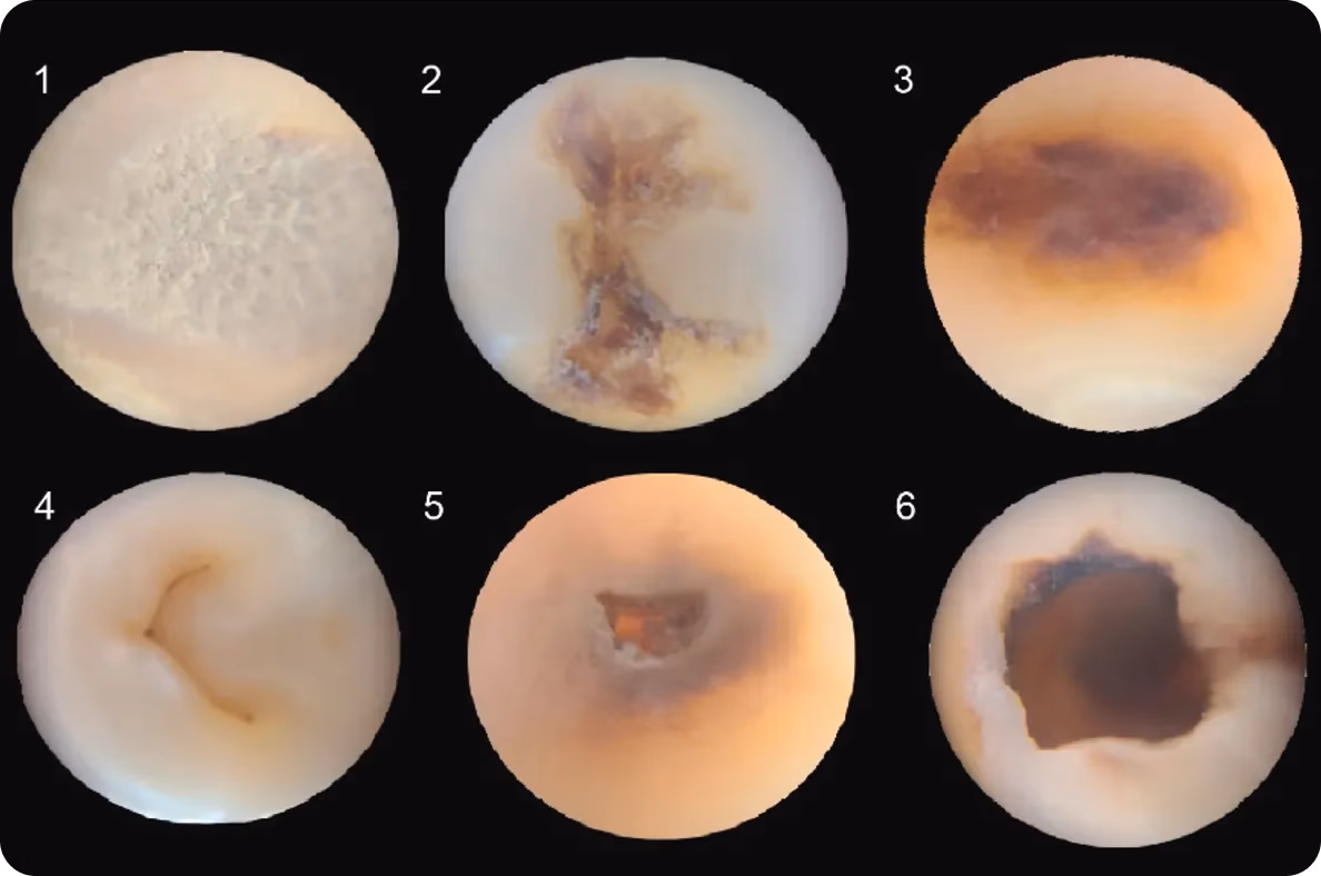 Microfotografía de las diferentes etapas de la caries dental