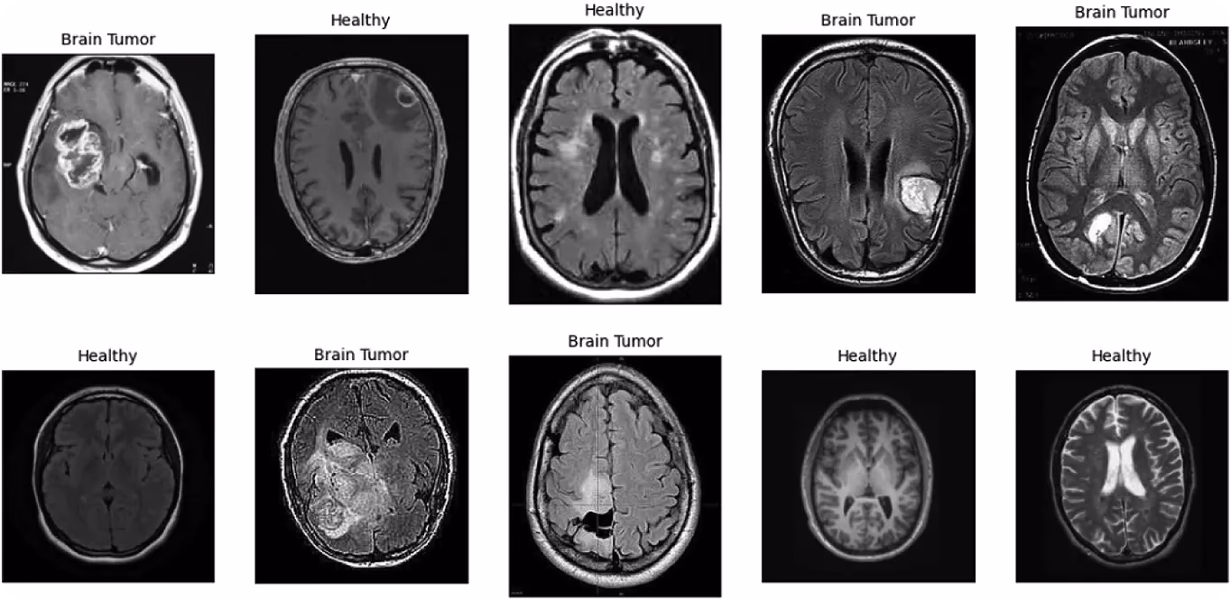 Rilevamento di tumori cerebrali in scansioni mediche basato su ResNet-50