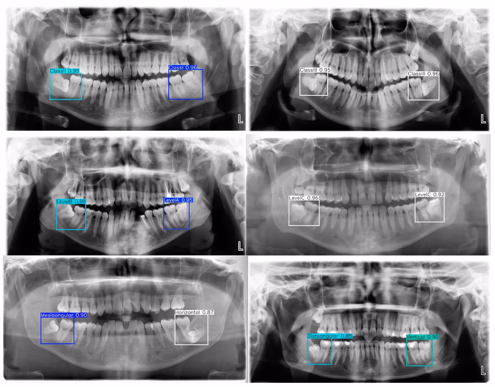 YOLO analyzing a medical X-ray image