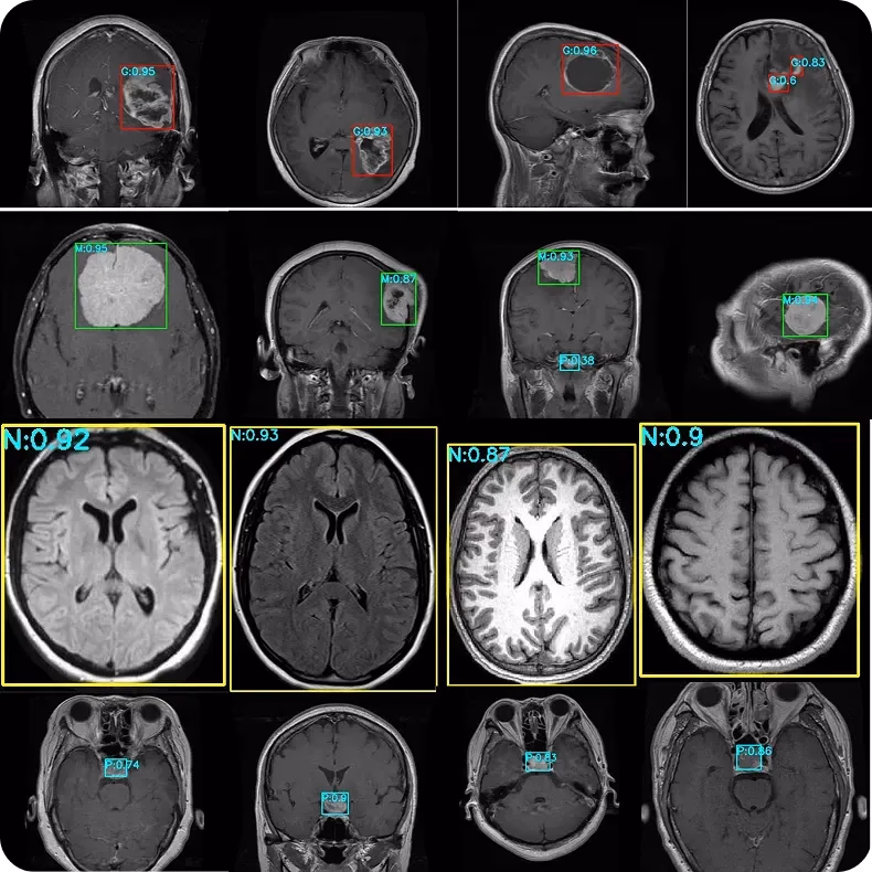 使用 YOLO11 检测并定位 MRI 扫描中的脑肿瘤