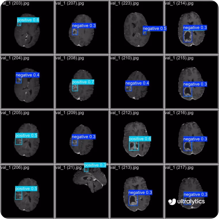 YOLO11 identifiant des anomalies dans des scans IRM cérébraux