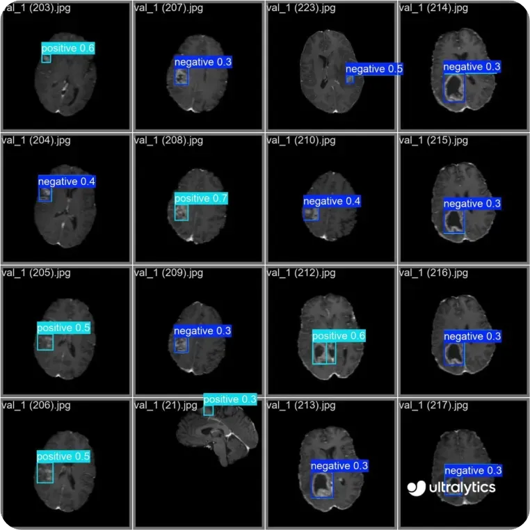 뇌 MRI 스캔에서 이상 소견을 식별하는 YOLO11