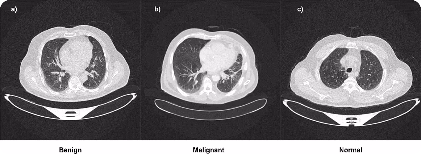 Classificazione delle immagini di tumori usando Lung-EffNet
