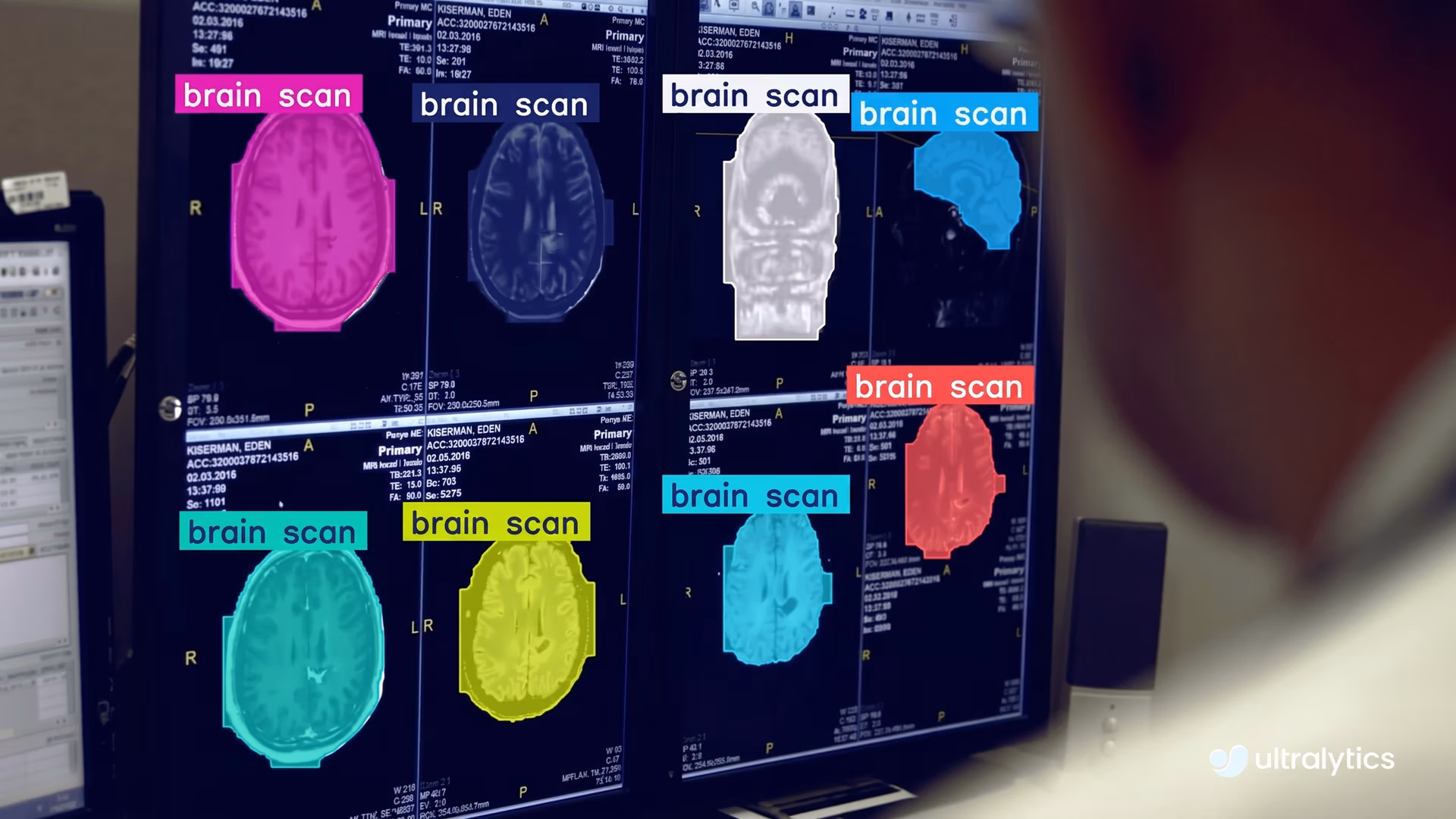 Segmenting brain scans using Ultralytics YOLO11