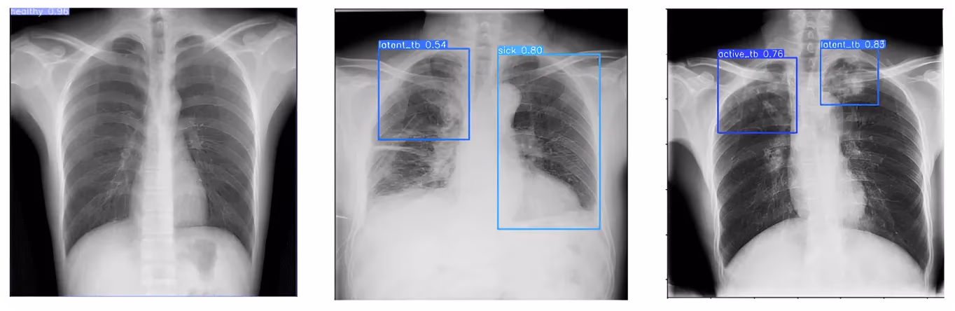 결핵 분류를 위해 비전 AI로 분석된 흉부 X-ray