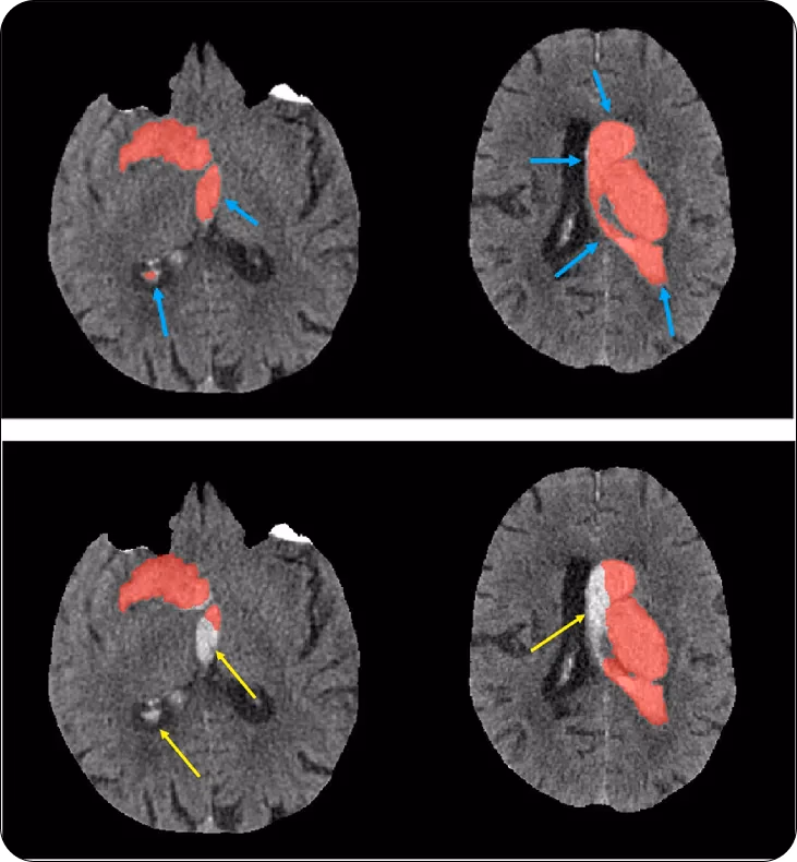 Segmentazione di lesioni da ictus emorragico in scansioni mediche tramite 3D U-Net
