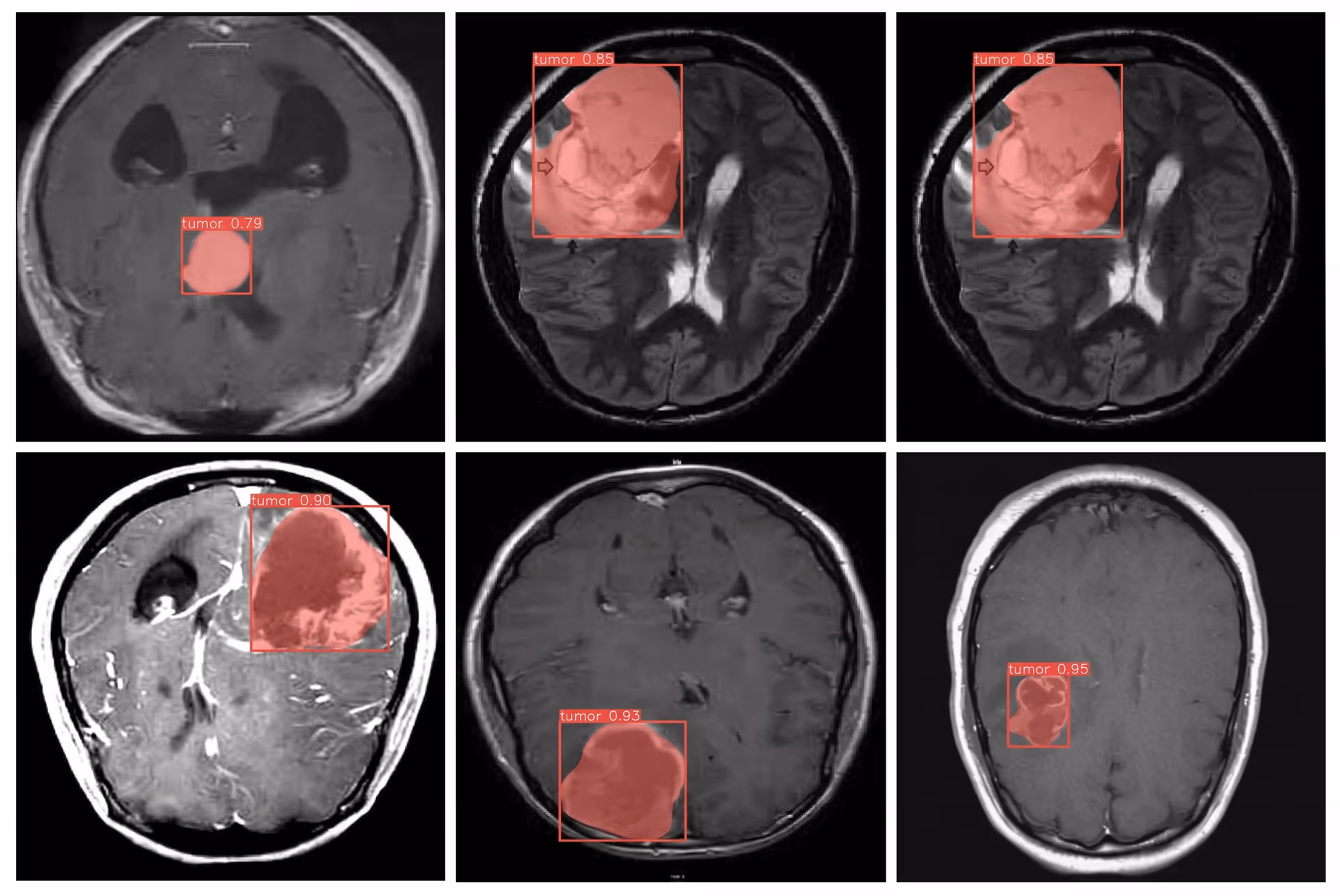 Using YOLOv8 to detect tumors