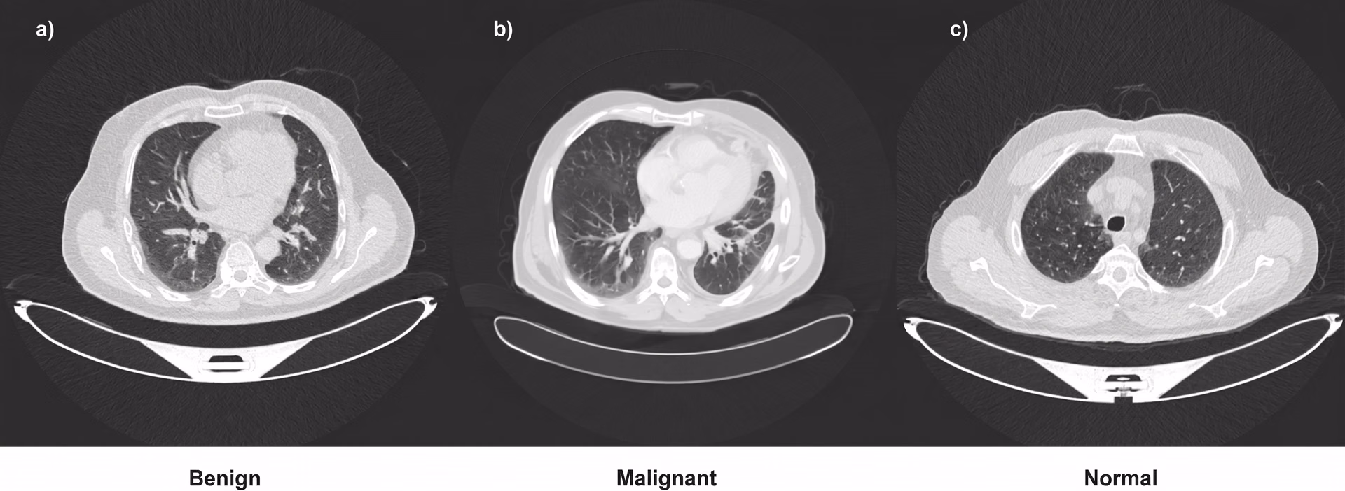 Classificazione delle immagini di tumori tramite Lung-EffNet