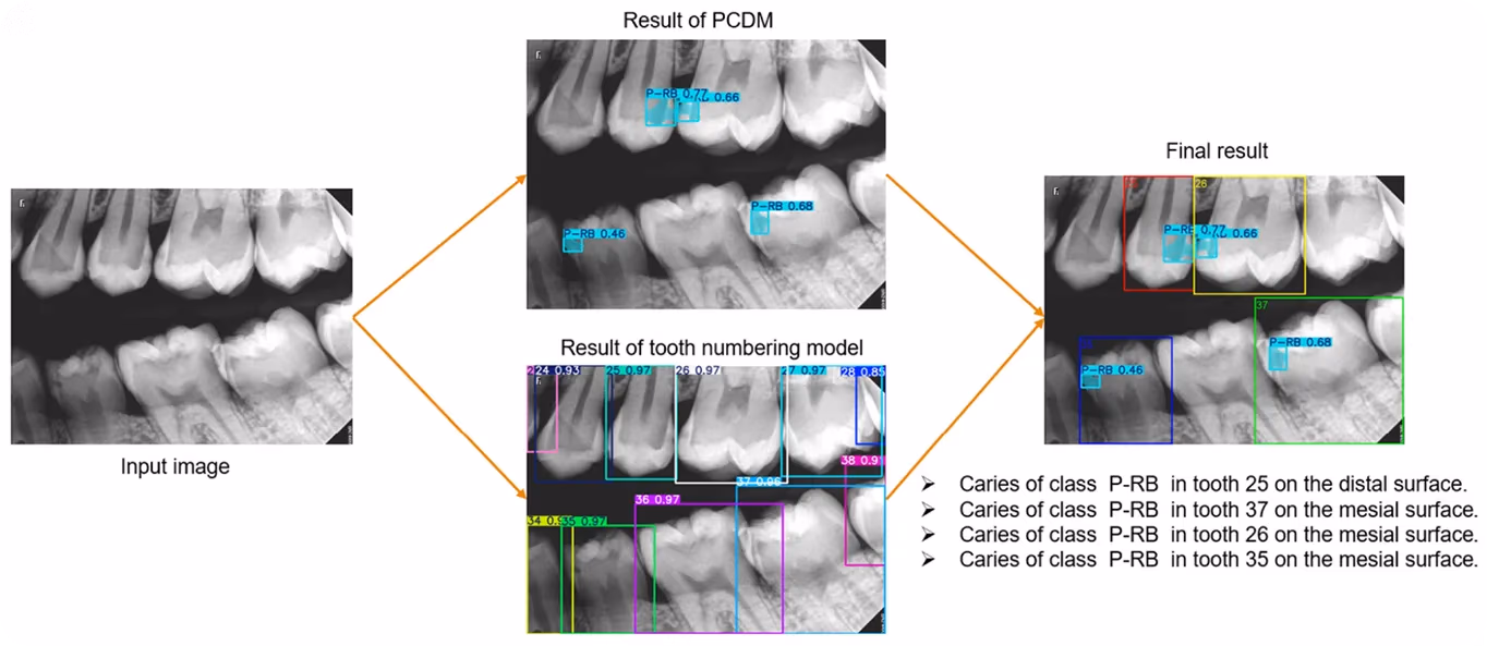 Detección de caries en radiografías dentales mediante YOLO11