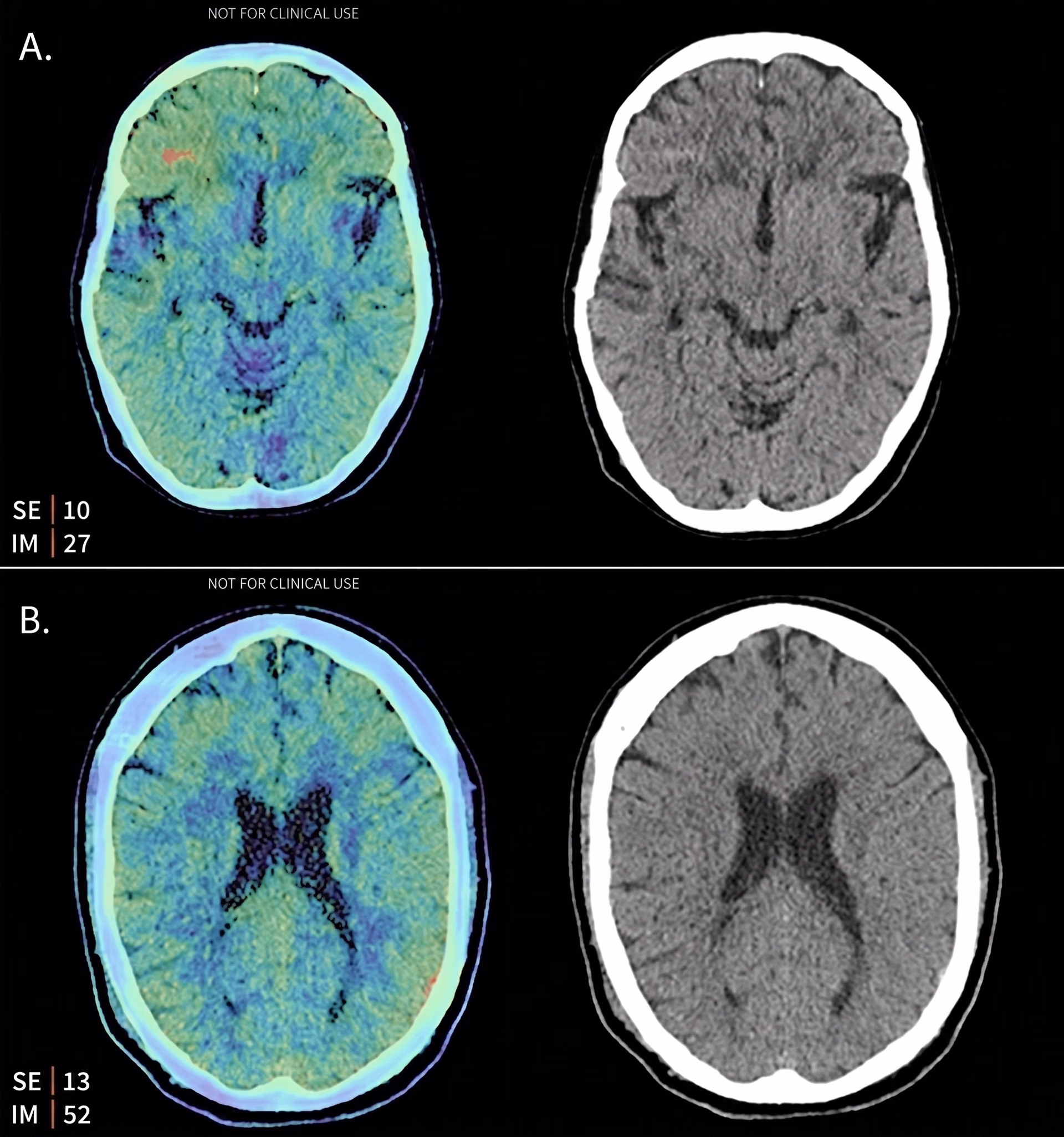 Intracranial hemorrhages detected on a brain scan by Aidoc