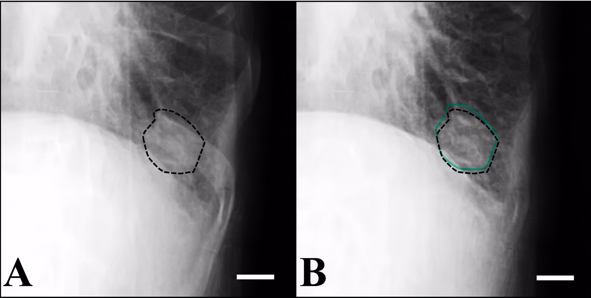 Lung tumour detection using template matching