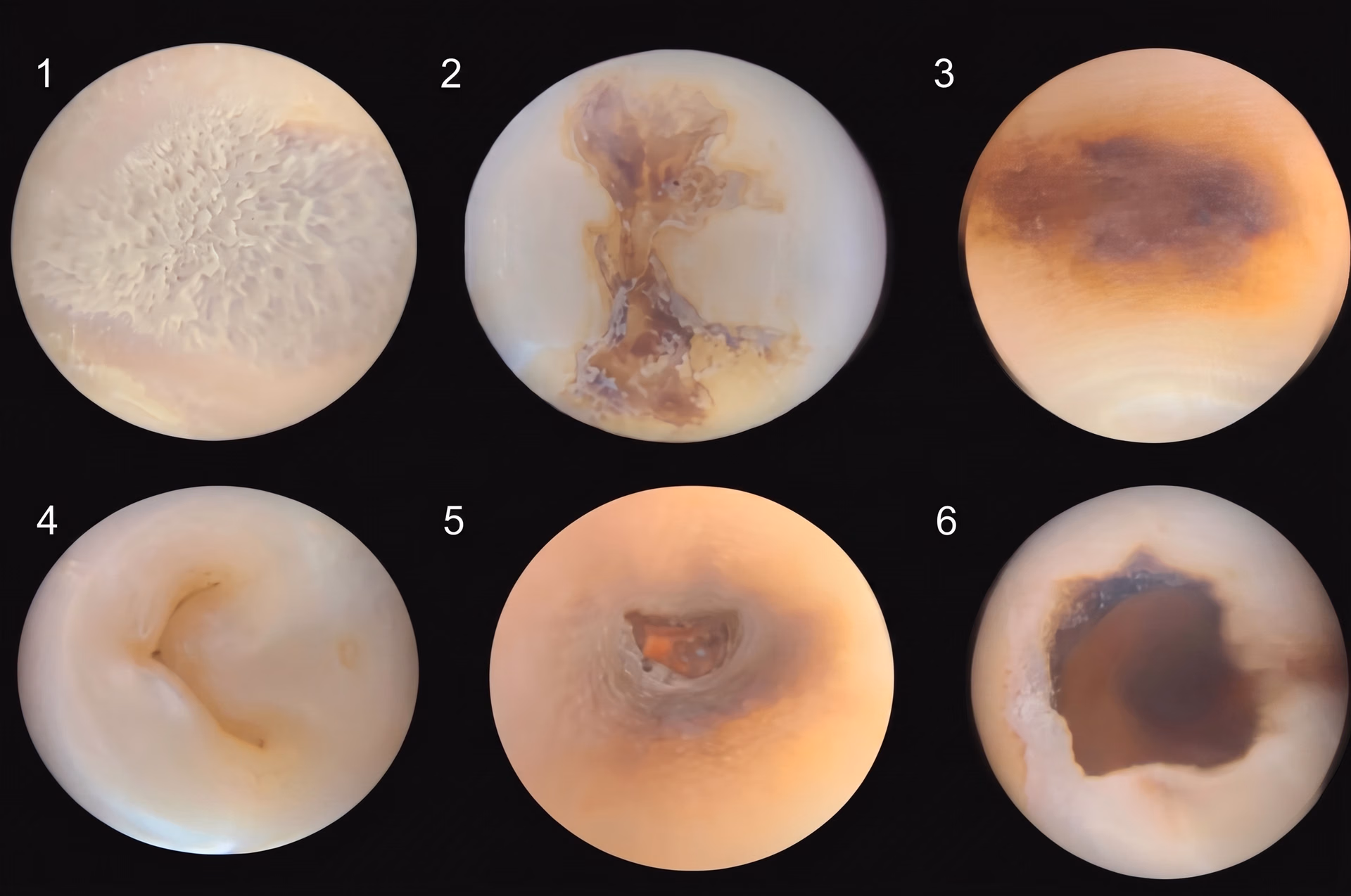 Microphotography of the different stages of tooth decay