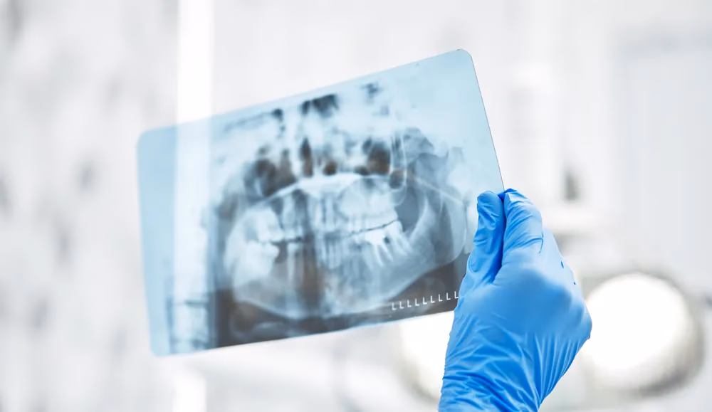 Detección de caries en dientes frontales con IA