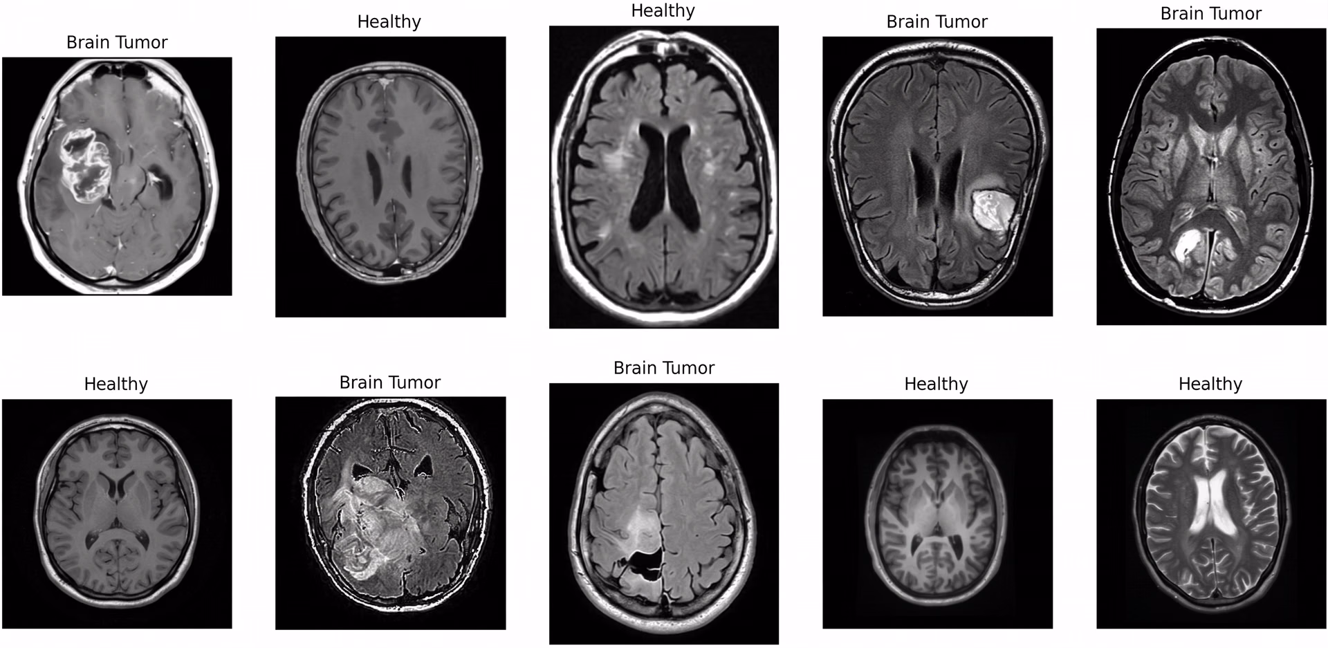 Brain tumor detection in medical scans based on ResNet-50