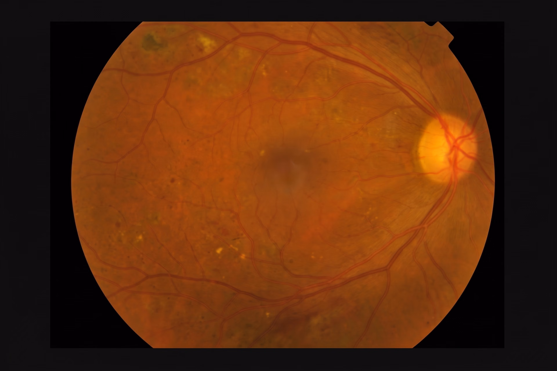 A retinal image processed by an AI assistant using MCP