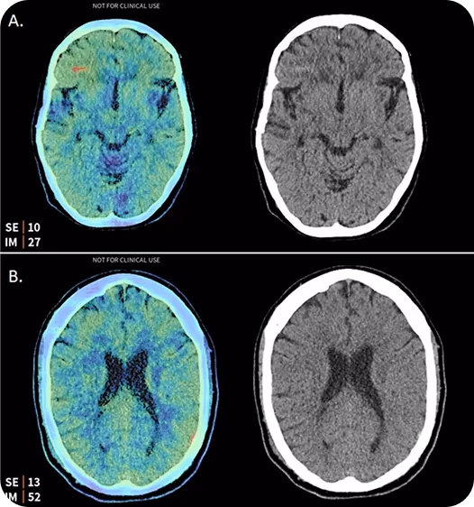 Hémorragies intracrâniennes détectées sur un scanner cérébral par Aidoc