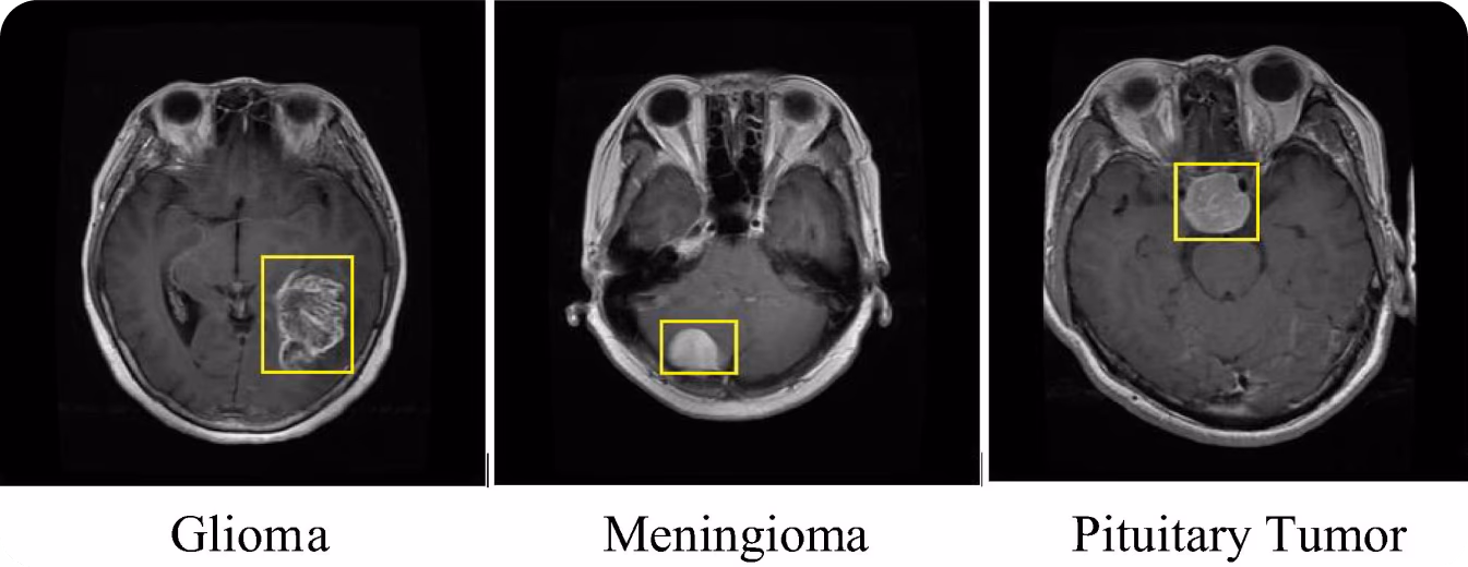 Rilevamento di tumori cerebrali utilizzando R-CNN