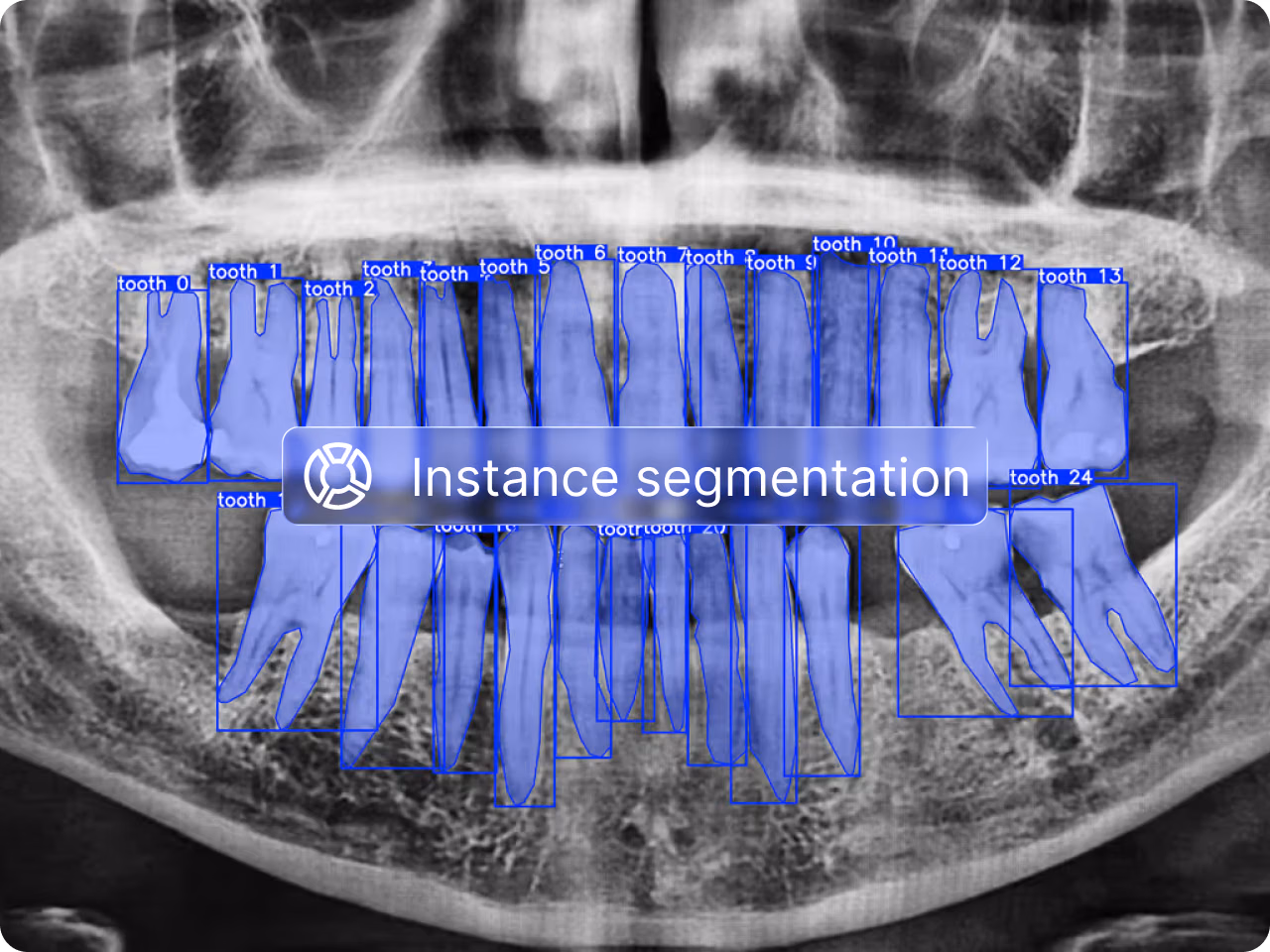 Instance segmentation: panoramic dental X-ray with teeth segmented by individual masks and numbered tooth labels.