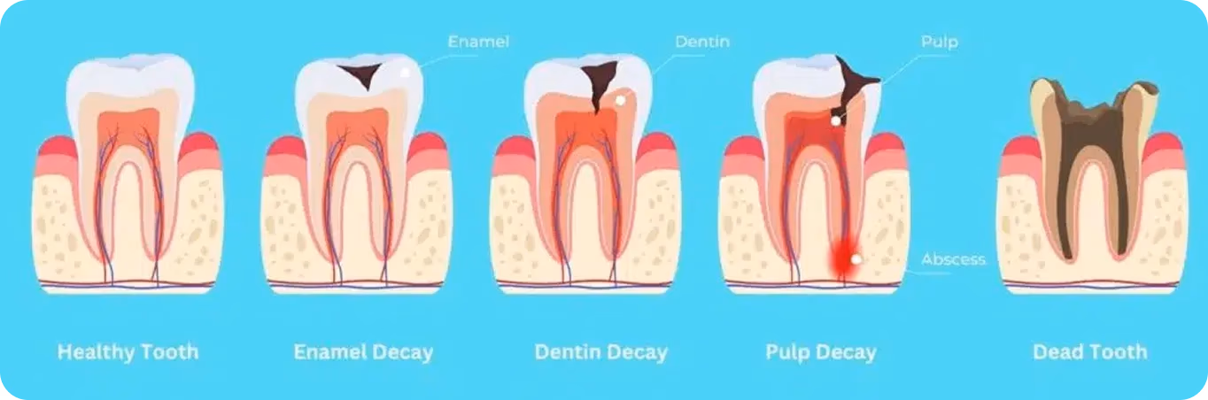 Las diferentes etapas de la caries dental